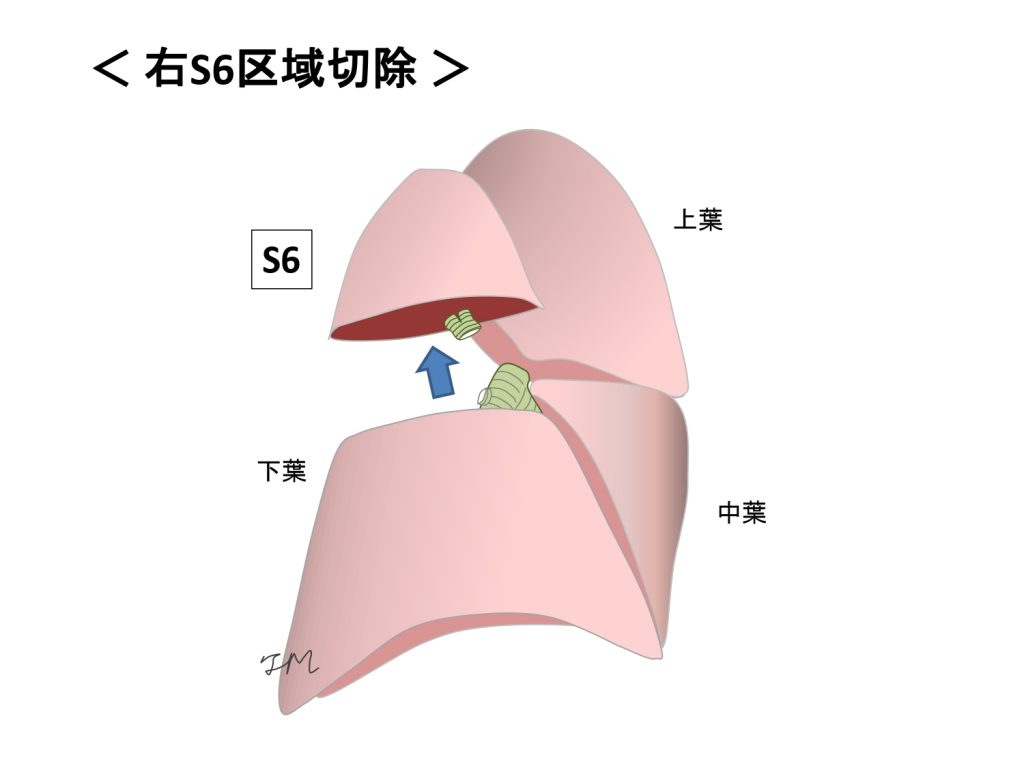 縮小手術S６