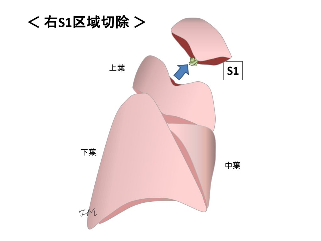 S1区域切除