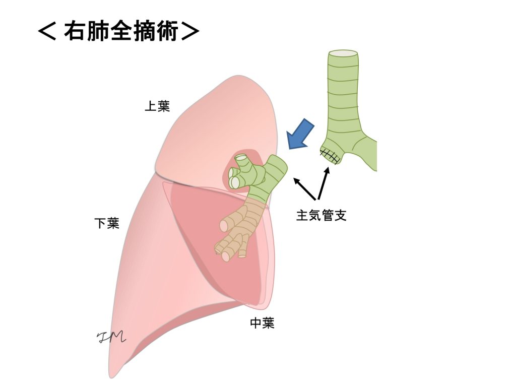 右肺全摘術