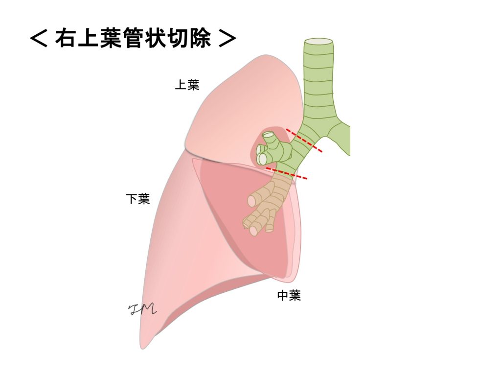 右上葉管状切除