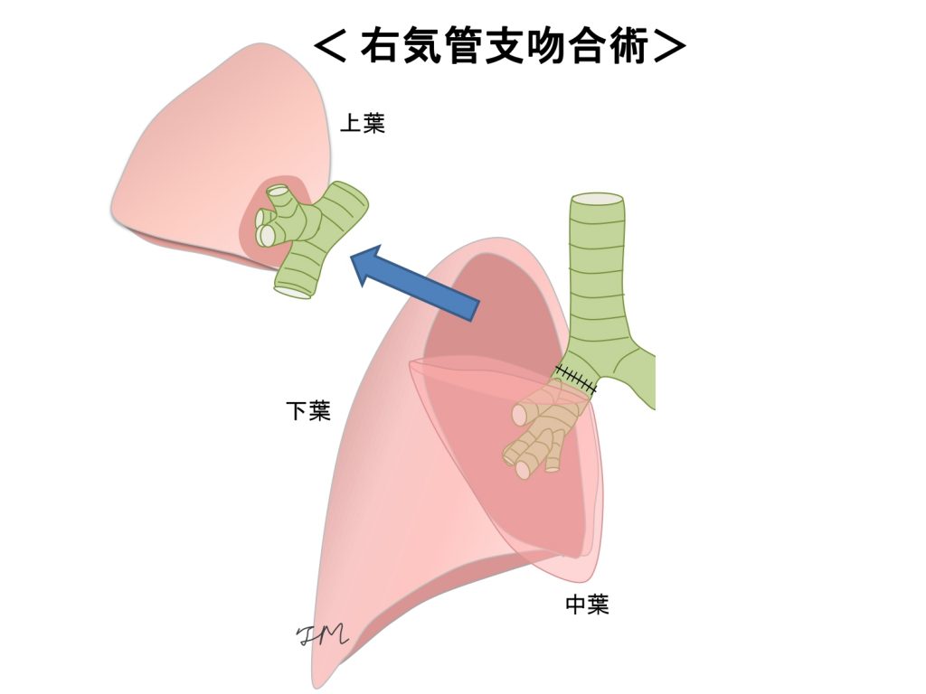 右気管支吻術