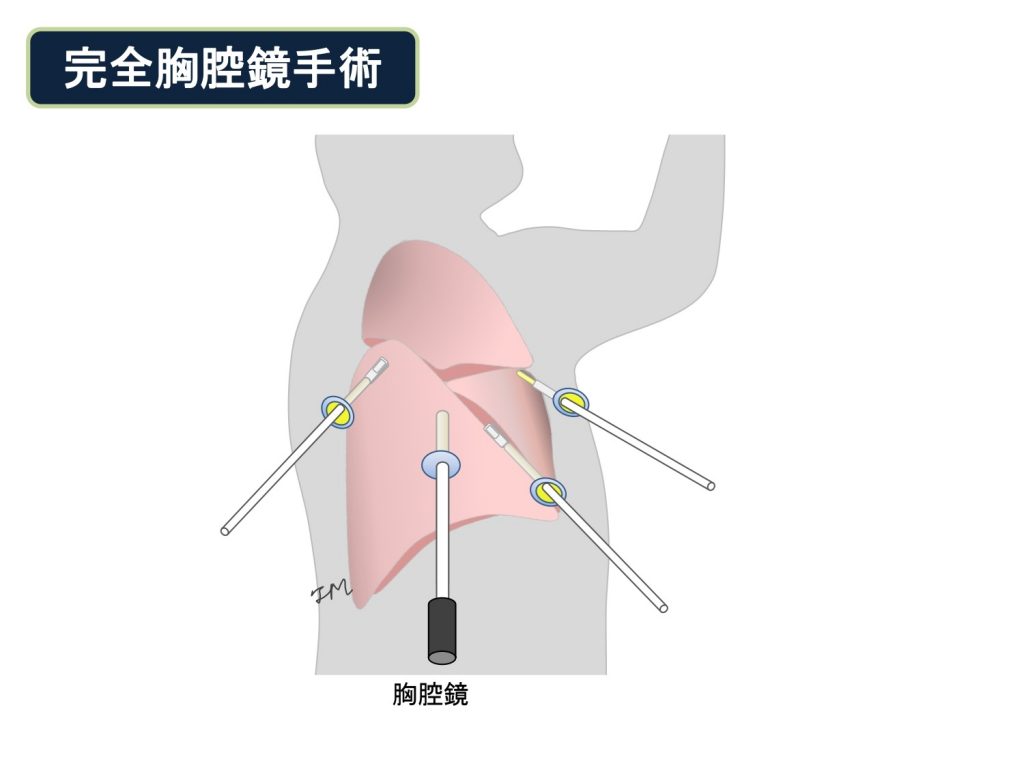 完全胸腔鏡手術