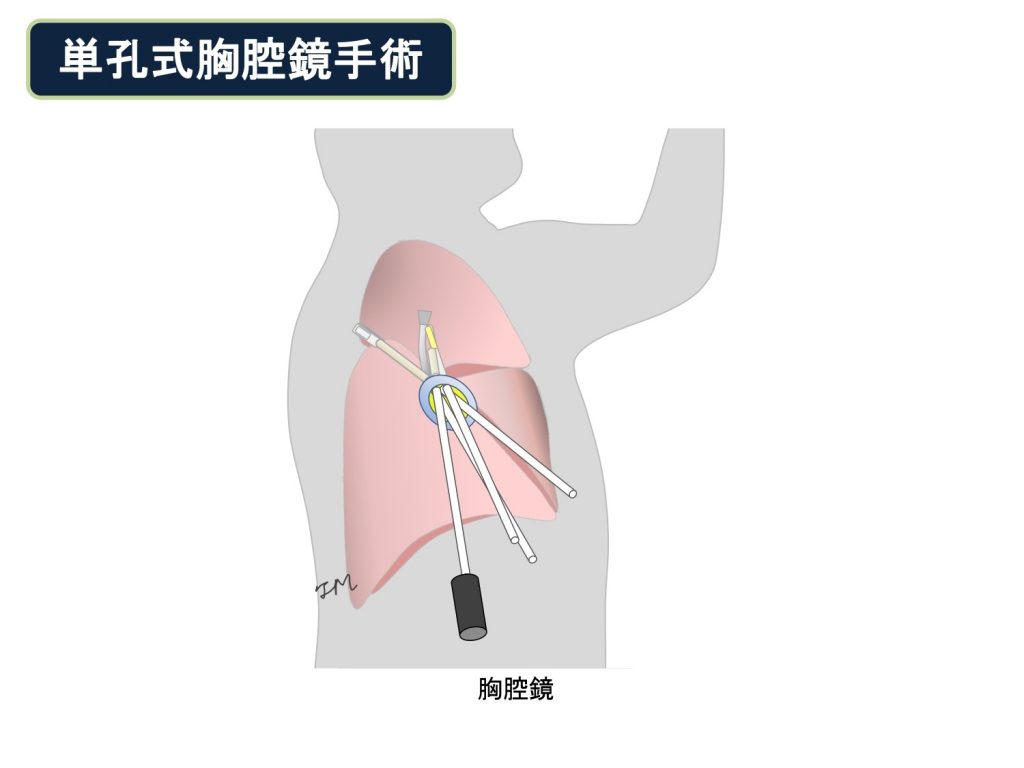 単孔式胸腔鏡手術