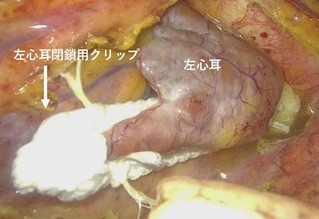 胸腔鏡を用いた左心耳閉鎖（内視鏡画像）